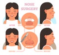 Nose plastic surgery vector illustration.