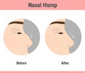 Nose reconstruction or nasal hump removal