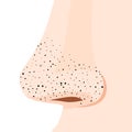 Nose side with blackheads or black dots or acne pimples, illustration close-up on white background