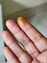 Not wearing gloves might lead to acid burning on fingers during laboratory work