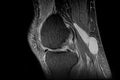 Nuclear Magnetic Resonance of right knee that shows baker cyst, fracture of external meniscus and hydrarthrosis. Royalty Free Stock Photo