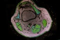 Nuclear Magnetic Resonance of right knee that shows baker cyst, fracture of external meniscus and hydrarthrosis. Royalty Free Stock Photo