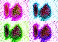 Nuclear medicine abnormal thyroid scan colors