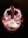 Nuclear medicine pet ct head neck oncology diagnostic