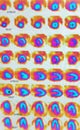 Nuclear myocardial perfusion stress test