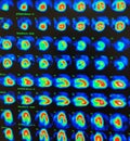 Nuclear myocardial perfusion stress test