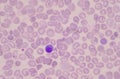 Nucleated Red Blood Cells NRC in blood smear