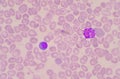 Nucleated Red Blood Cells NRC in blood smear