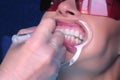 Nurse applying gel for LED whitening woman patient teeth in dentistry, closeup.