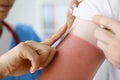 Nurse applying protective cream to skin of hand with burn closeup