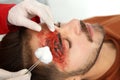 Nurse cleaning young man`s head injury in clinic, closeup.