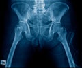 Osteoarthritis hip or OA Royalty Free Stock Photo