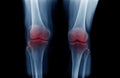 OA knee x-ray image on blue color with black background