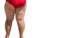 Obese female legs.