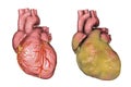 Obese heart, illustration