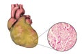 Obese heart, illustration Royalty Free Stock Photo