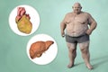 Obese heart and liver in overweight man, 3D illustration. Concept of obesity and inner organs disease Royalty Free Stock Photo