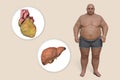 Obese heart and liver in overweight man, 3D illustration. Concept of obesity and inner organs disease