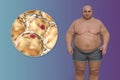 Obese man and close-up view of fat cells, 3D illustration. Concept of obesity
