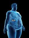 An obese mans adrenal glands Royalty Free Stock Photo