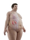 An obese mans kidneys Royalty Free Stock Photo