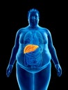 An obese mans liver Royalty Free Stock Photo