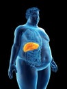 An obese mans liver Royalty Free Stock Photo