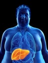 An obese mans liver Royalty Free Stock Photo