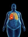 An obese mans lung tumor Royalty Free Stock Photo