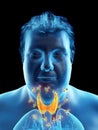 An obese mans thyroid gland being attacked by antibodies