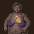 An obese woman with ascending aortic aneurysm, 3D illustration