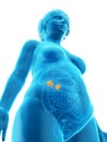 An obese womans adrenal glands Royalty Free Stock Photo