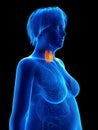 An obese womans thyroid gland Royalty Free Stock Photo