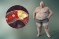 Obesity and atherosclerosis, conceptual 3D illustration. Atheromatous plaque inside artery leading to narrowing of blood vessel in Royalty Free Stock Photo