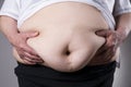 Obesity woman body, fat female belly with a scar from abdominal surgery close up