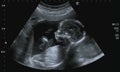 Obstetric Ultrasonography Royalty Free Stock Photo