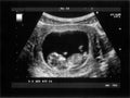 Obstetric Ultrasonography Royalty Free Stock Photo
