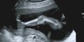 Obstetric Ultrasonography Royalty Free Stock Photo
