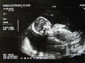 Obstetric Ultrasonography Ultrasound Echography of a fourth month fetus Royalty Free Stock Photo