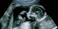 Obstetric Ultrasonography Ultrasound Echography of a first months fetus