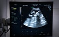 Obstetric Ultrasound of fetus