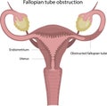 Obstruction of the fallopian tubes.