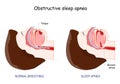 Obstructive Sleep Apnea. normal breathing, and  anatomy of Snoring. Royalty Free Stock Photo