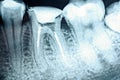 Obturation of Root Canal Systems On X-Ray