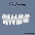 Occlusion side view