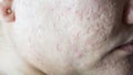 Occurrence of infected sebaceous glands in the skin