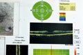 OCT of the eye reveals faint epimacular membrane and full thickness macular hole involving the fovea, surrounding diffuse macular