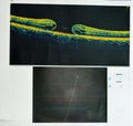 OCT of the eye reveals faint epimacular membrane and full thickness macular hole involving the fovea, surrounding diffuse macular