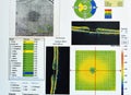 OCT of the eye reveals faint epimacular membrane and full thickness macular hole involving the fovea, surrounding diffuse macular