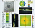 OCT of the eye reveals faint epimacular membrane and full thickness macular hole involving the fovea, surrounding diffuse macular